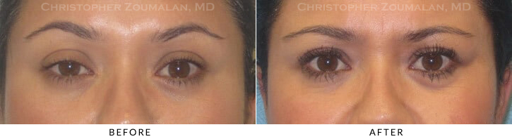 Ptosis Surgery Before & After Photo -  - Patient 19