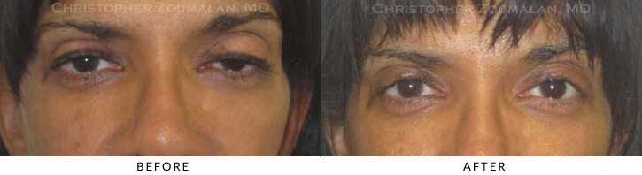 Ptosis Surgery Before & After Photo -  - Patient 20