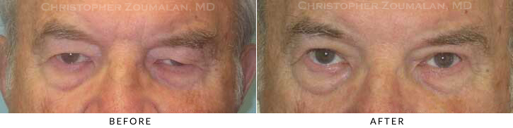 Ptosis Surgery Before & After Photo -  - Patient 21