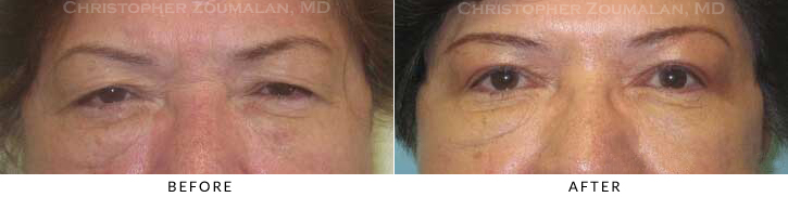 Ptosis Surgery Before & After Photo -  - Patient 22
