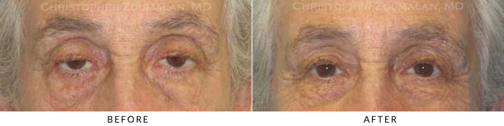 Ptosis Surgery Before & After Photo -  - Patient 25