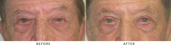 Ptosis Surgery Before & After Photo -  - Patient 26