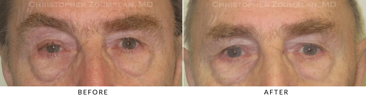 Ptosis Surgery Before & After Photo - Patient Seeing Straight - Patient 27B