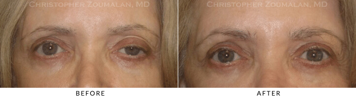 Ptosis Surgery Before & After Photo -  - Patient 28