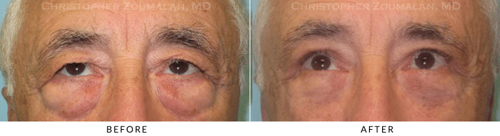 Ptosis Surgery Before & After Photo -  - Patient 29