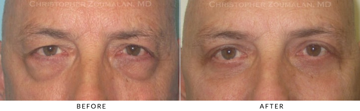 Ptosis Surgery Before & After Photo -  - Patient 30