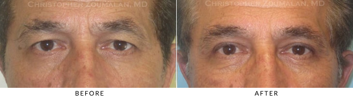 Ptosis Surgery Before & After Photo -  - Patient 31