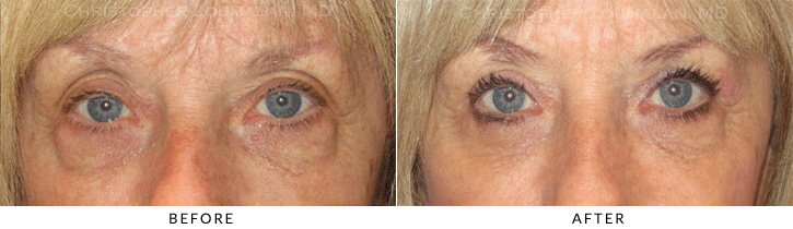 Ptosis Surgery Before & After Photo - Patient Seeing Straight - Patient 33A