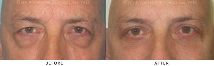 Ptosis Surgery Before & After Photo -  - Patient 35