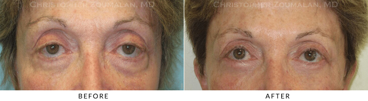 Ptosis Surgery Before & After Photo -  - Patient 38