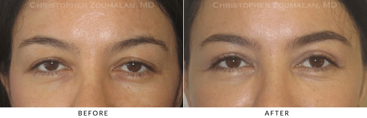 Ptosis Surgery Before & After Photo -  - Patient 39
