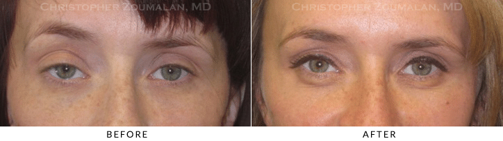 Ptosis Surgery Before & After Photo -  - Patient 40