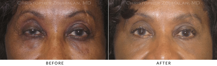 Ptosis Surgery Before & After Photo -  - Patient 41