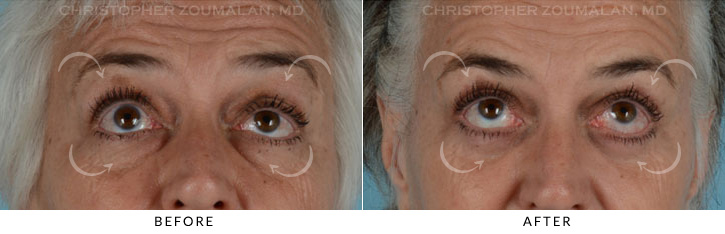 Ptosis Surgery Before & After Photo - Patient Seeing Up - Patient 6B