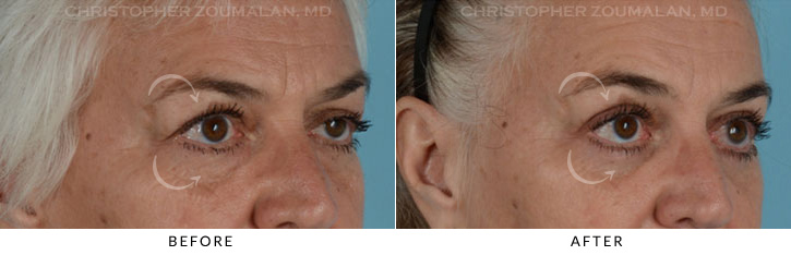 Ptosis Surgery Before & After Photo - Patient Seeing Side - Patient 6D