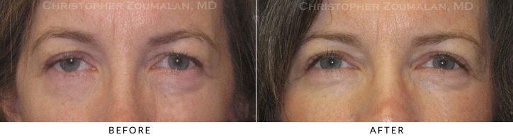 Ptosis Surgery Before & After Photo -  - Patient 42