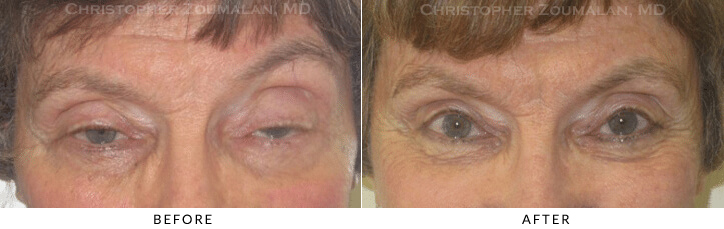 Ptosis Surgery Before & After Photo -  - Patient 43