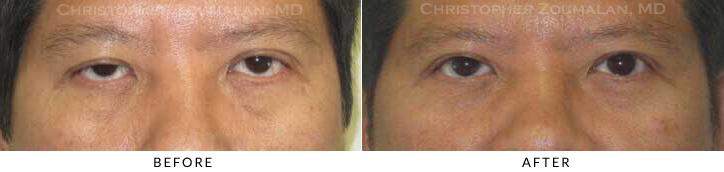 Ptosis Surgery Before & After Photo -  - Patient 45