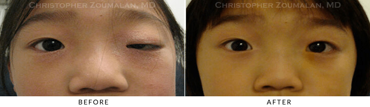 Ptosis Surgery Before & After Photo -  - Patient 47