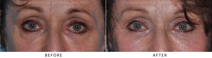Ptosis Surgery Before & After Photo -  - Patient 49