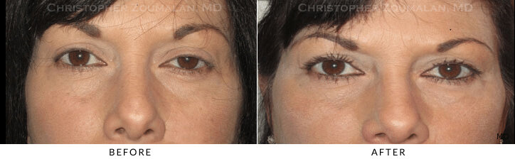 Ptosis Surgery Before & After Photo -  - Patient 48