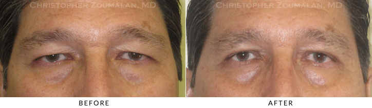 Ptosis Surgery Before & After Photo -  - Patient 50