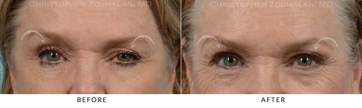 Ptosis Surgery Before & After Photo -  - Patient 7