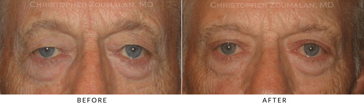 Ptosis Surgery Before & After Photo -  - Patient 53