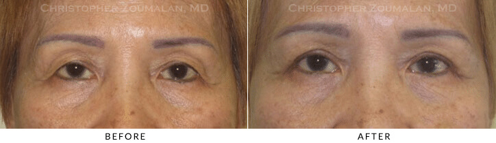 Ptosis Surgery Before & After Photo -  - Patient 54