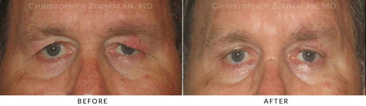 Ptosis Surgery Before & After Photo -  - Patient 55