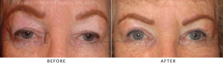 Ptosis Surgery Before & After Photo -  - Patient 56