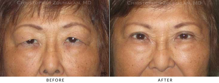 Ptosis Surgery Before & After Photo -  - Patient 57