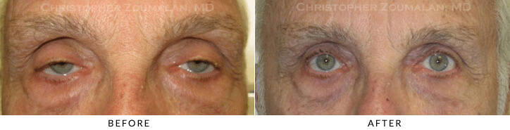Ptosis Surgery Before & After Photo -  - Patient 58
