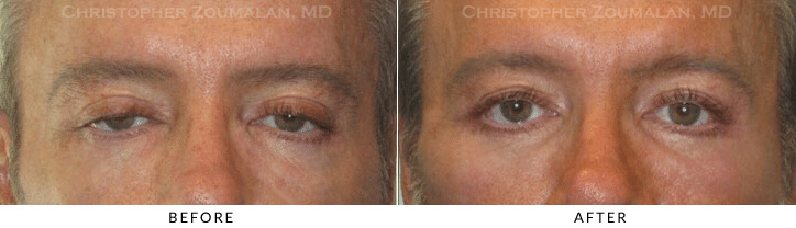 Ptosis Surgery Before & After Photo -  - Patient 59