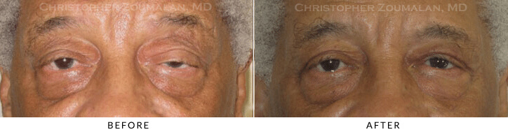 Ptosis Surgery Before & After Photo -  - Patient 60