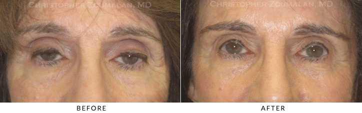 Ptosis Surgery Before & After Photo -  - Patient 61