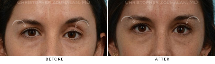 Ptosis Surgery Before & After Photo -  - Patient 8