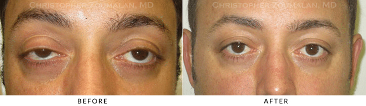 Ptosis Surgery Before & After Photo -  - Patient 62