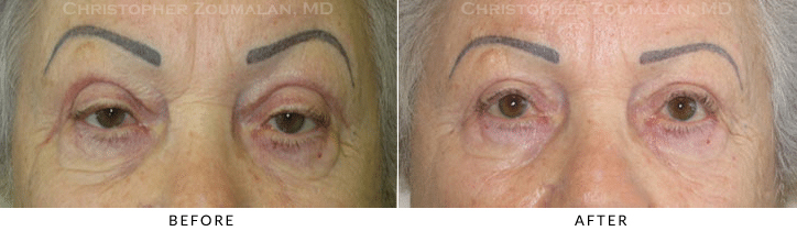 Ptosis Surgery Before & After Photo -  - Patient 63