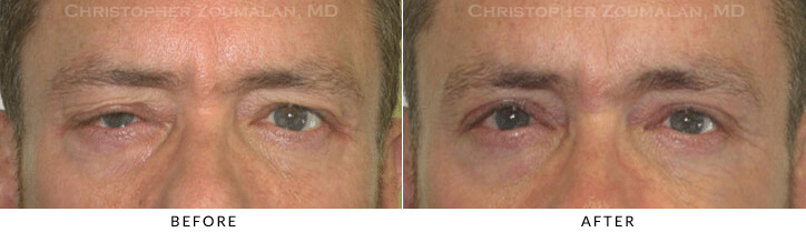 Ptosis Surgery Before & After Photo -  - Patient 64