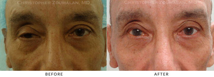 Ptosis Surgery Before & After Photo -  - Patient 65