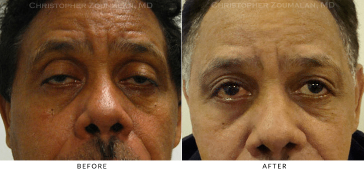 Ptosis Surgery Before & After Photo -  - Patient 66