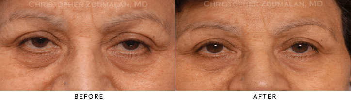 Ptosis Surgery Before & After Photo -  - Patient 67