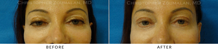 Ptosis Surgery Before & After Photo -  - Patient 68