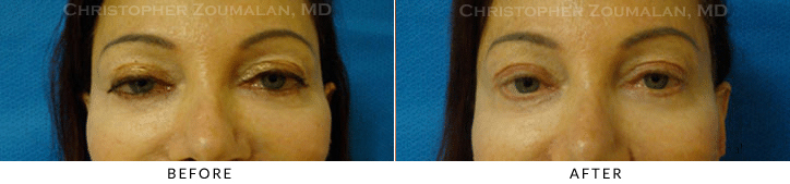 Ptosis Surgery Before & After Photo -  - Patient 68