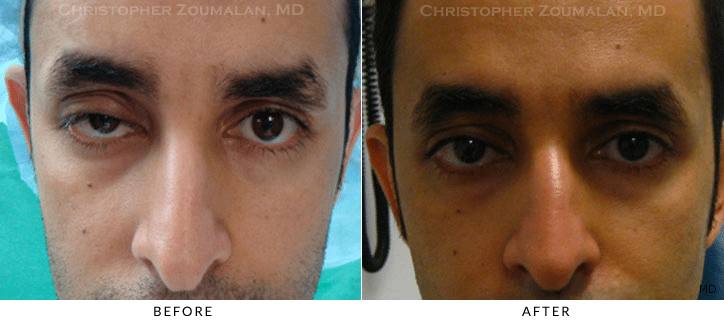 Ptosis Surgery Before & After Photo -  - Patient 69