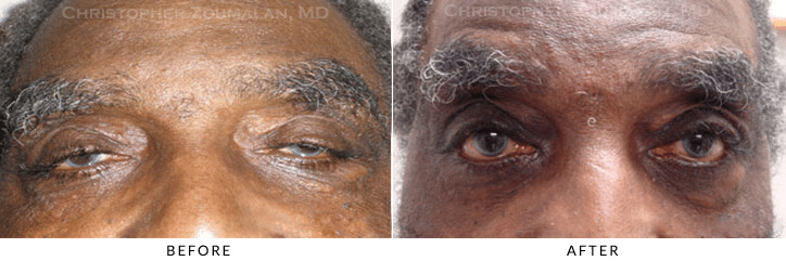 Ptosis Surgery Before & After Photo -  - Patient 70