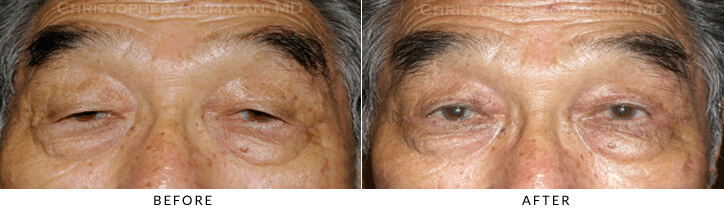 Ptosis Surgery Before & After Photo -  - Patient 71