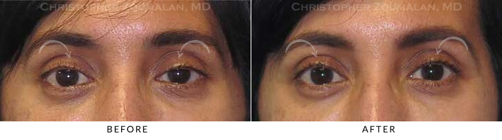 Ptosis Surgery Before & After Photo -  - Patient 9