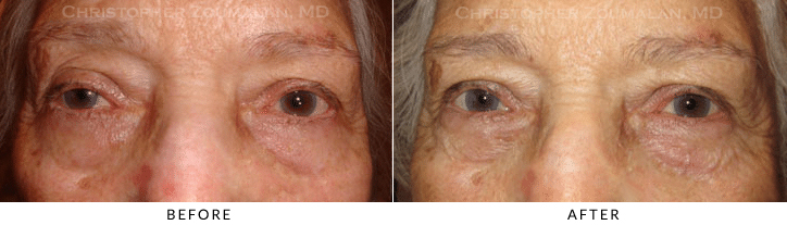 Ptosis Surgery Before & After Photo -  - Patient 72